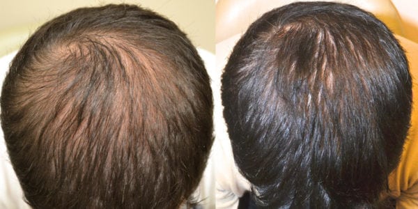 Propecia Before And After Photos Dr Rogers New Orleans