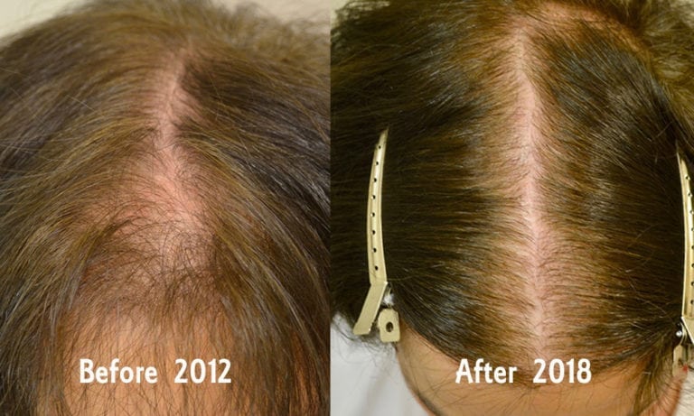 Spironolactone For Females Only Before And After Photos Hair Restoration Of The South New 6575