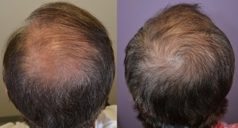 Minoxidil + Finasteride For Crown (vertex) Hair Loss - Hair Restoration 