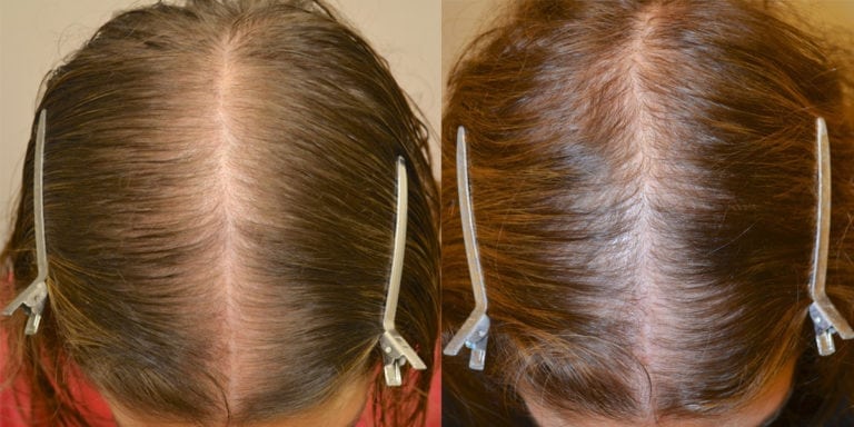 Spironolactone For Females Only Before And After Photos Hair Restoration Of The South New 