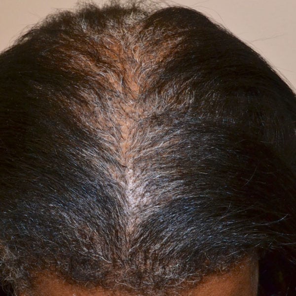 African American Hair Transplant - New Orleans, Louisiana