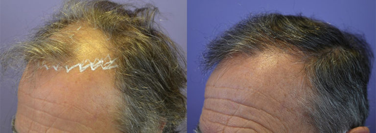 FUT Hairline Restoration On A 66 Year Old Male - Norwood Class 5 Hair ...