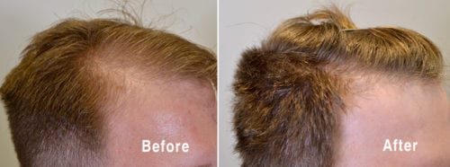 Did my hair improve with finasteride? - Hair Restoration of the South