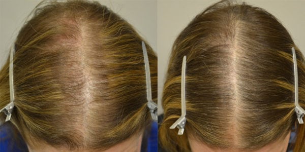 Spironolactone For Females Only Before And After Photos Hair