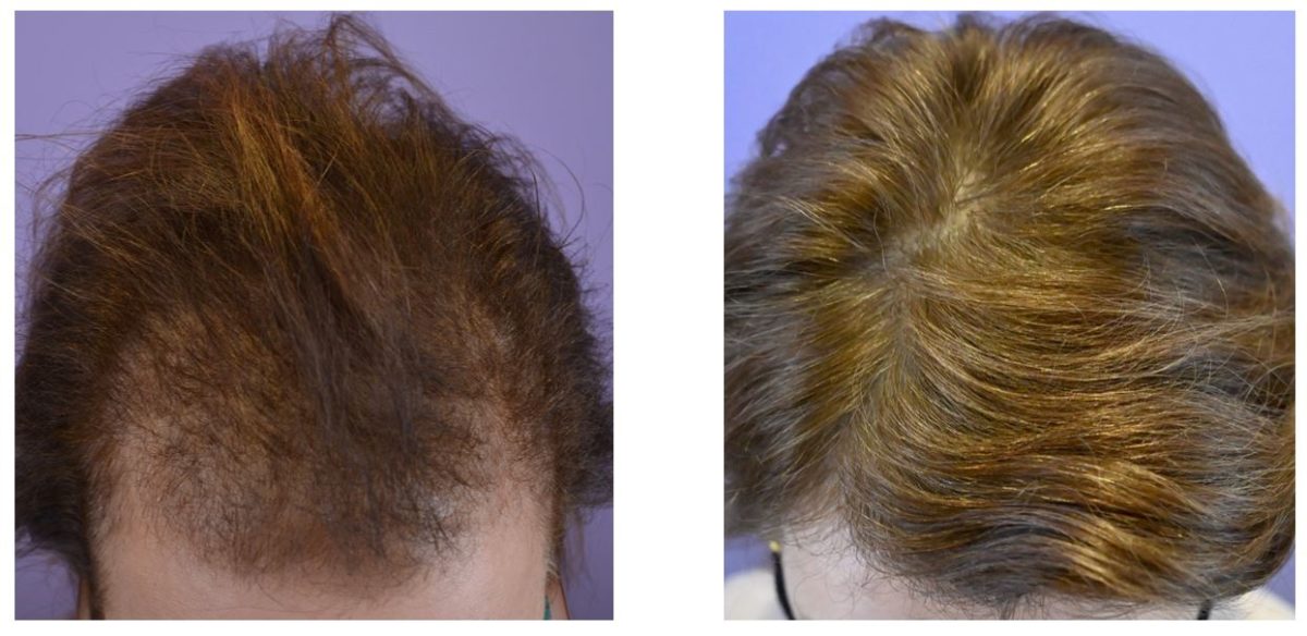 Hair Loss Treated After Chemo Therapy For Breast Cancer - Hair ...