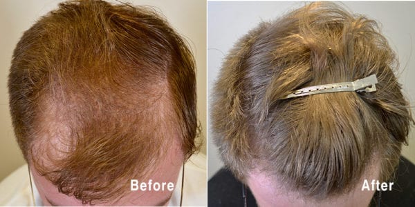 Propecia Before And After Photos - Dr Rogers - New Orleans