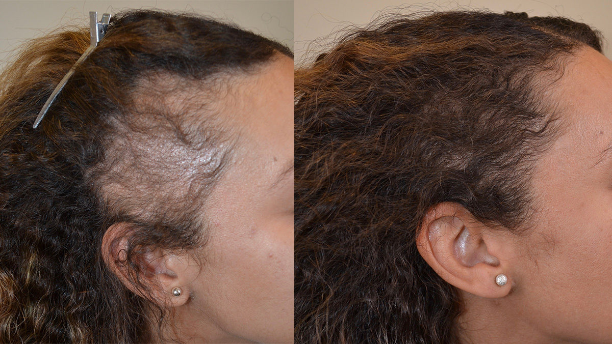 finasteride hair loss study
