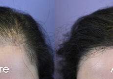 Front view, before and after 1,151 hair grafts transplanted.