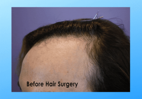 Timelapes images of the patients progress after hair transplant surgery